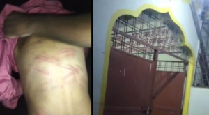 बच्चे की पीठ पर निशान